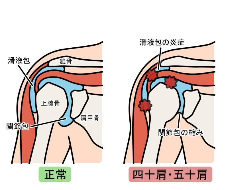 五十肩