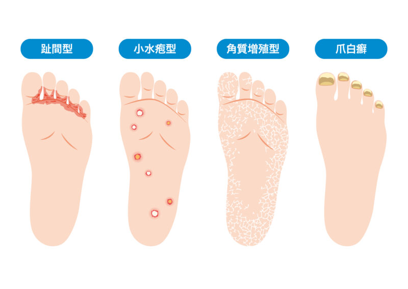 水虫は4種類