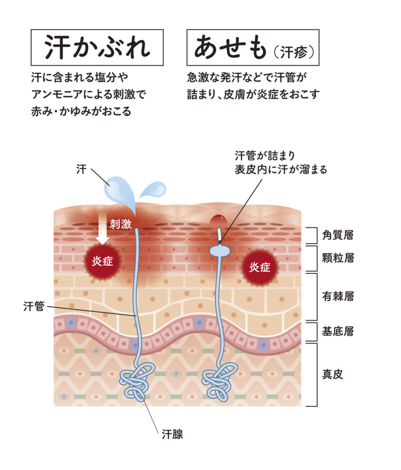 あせもとかぶれの違い