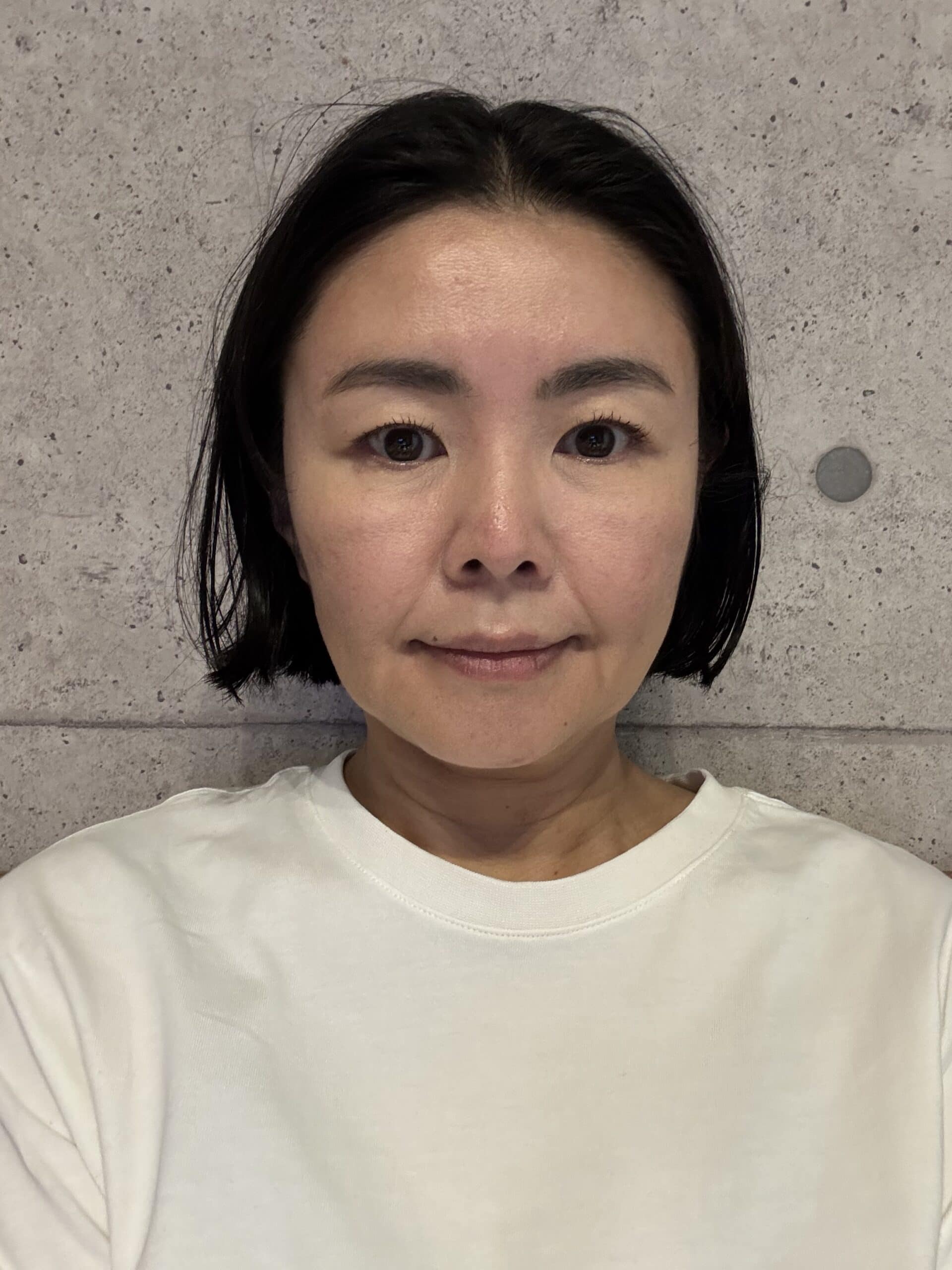 VANDS CLINIC (ベンスクリニック)でオンダリフト＆リジュランプレミアムを受けた後